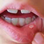 Best Homeopathic Medicine For Mouth Ulcer