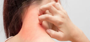 Terms Associated With Common Skin Rashes
